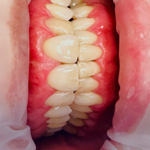 Tandvleesbehandeling (Parodontitis)