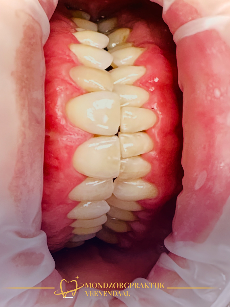 Tandvleesbehandeling (Parodontitis)