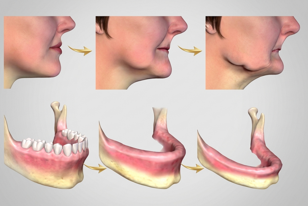Illustratie van kaakbotresorptie (slinken van de kaak) na het trekken van tanden en de invloed op de pasvorm van een prothese.