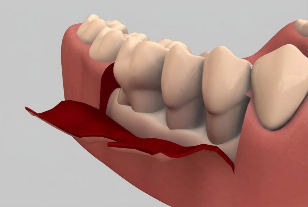 Medische illustratie van een flapoperatie waarbij het tandvlees wordt opgetild om diepe bacteriële reiniging van de wortels mogelijk te maken.